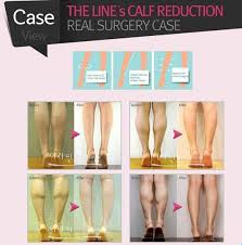 Calf Reduction Surgery Calf Liposuction Korea Calf Exercises Reduction Surgery Slim Calves