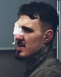 Tom Aspinall's eye surgery update. J TikTok @middleoftgecage Tom Aspinall  gives α update