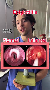 Image result for Epiglottitis