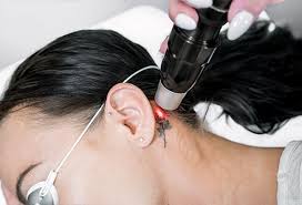Removal is harder than the procedure of its application. Can You Completely Remove A Tattoo
