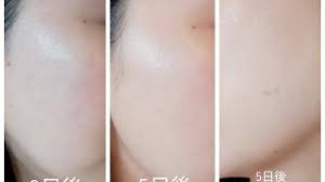 シミ取りクリーム レチンa デラニン ヒルドイドの効果について asia beauty log ヒルドイド アンチエイジングクリーム エンビロン