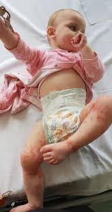 Find stockbilleder af newborn baby baby rash soft focus i hd og millionvis af andre royaltyfri stockbilleder, illustrationer og vektorer i shutterstocks samling. Mom Speaks Out After Daughter Gets Herpes From Stranger Kissing Her On The Lips People Com