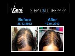Bala respected sir, my problem hair totally damage so i am coming to vcare clinic velacherry ,my problem explain doctor archana so doctor explain only cosmetic hair fixing only cosmetic hair very natural hair original hair human original hair look so you fixing cosmetic hair. Vcare Stem Cell Therapy Youtube