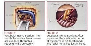 Vertigo Surgical Treatment Of Menieres Syndrome Ear Conditions And Treatments Michigan Ear Institute Farmington Hills Dearborn Royal Oak Novi Mi