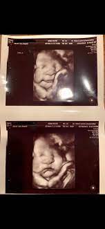 This cutting edge imaging is also known as 5d ultrasound. Got My 3d 4d Ultrasound At 35 Weeks Too Cute Not To Share January 2020 Babies Forums What To Expect
