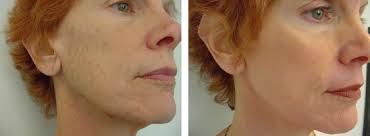 Basic chemical peeling: Superficial and medium-depth peels