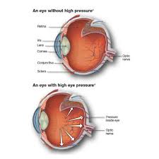 Image result for Intraocular Pressure
