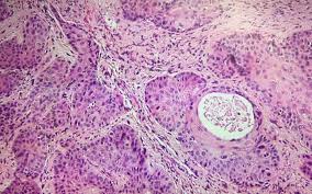 Image result for spinocellular carcinoma of the oral cavity