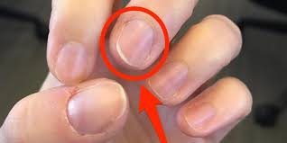 Cerebral small vessel disease and chronic kidney disease (ckd): 4 Health Secrets Hiding In Your Nails