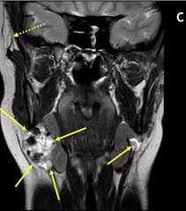 Image result for Sialolithiasis
