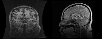 Pituitary Stalk Interruption Syndrome And Liver Changes From Clinical Features To Mechanisms