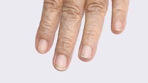 Deuten Die Weissen Flecken Auf Den Fingernageln Auf Nahrstoffmangel Hin Welt Der Wunder Tv