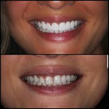 Carecredit® is designed for your dental needs. Why Colombia Is The Best Place To Get Porcelain Veneers Abroad Dental Tourism Colombia Dental Tourism Colombia
