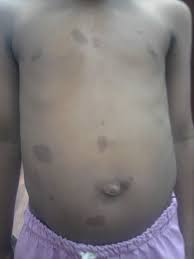 They are caused by an increased amount of melanin in both melanocytes and epidermal cells, and may increase in number with age. Webmedcentral Com Multiple Cafe Au Lait Spots