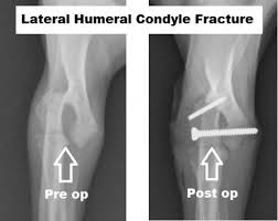 Lateral epicondyle (epicondylus lateralis) is a rounded projection at the distolateral end of the humerus. Surgical Management Of Lateral Humeral Condylar Fractures