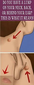 Do You Have A Lump On Your Neck Back Or Behind Your Ear This Is What It Means Skin Health Beauty Care Epidermoid Cyst Neck Lump Behind Ear