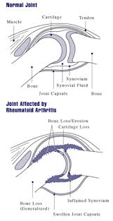 rheumatoid arthritis wikipedia