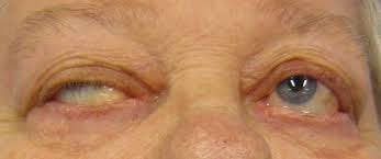 Department of agriculture and the u.s. Myasthenia Gravis Wikipedia