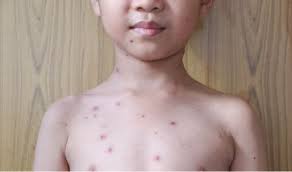 Suhu tubuh yang semakin naik akan sangat berbahaya jika. Pengalaman Ketika Anakku Terkena Campak Dan Cacar Air Antie Info