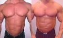 Gynecomastia-Male Breast Development