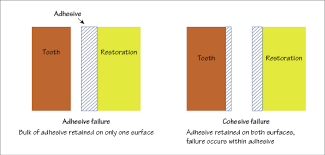 Jul 28, 2021 · adhesion. 4 Adhesion And Cohesion Pocket Dentistry