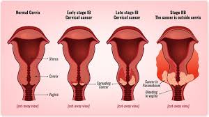Removing the area of abnormal cells. Minimally Invasive Surgery For Cervical Cancer May Not Be A Good Idea Finds A Pair Of Studies