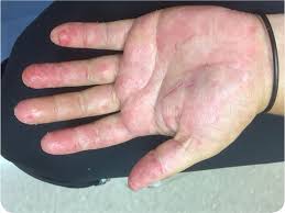 I try not to scratch as this usually results in oozing and makes wearing shoes. Pruritic Rash On The Hands And Feet Photo Quiz American Family Physician