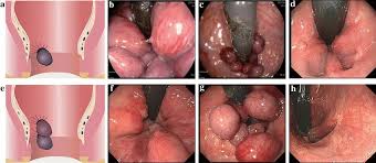Image result for Hemorrhoid
