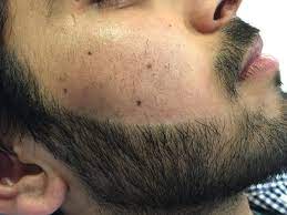 A fine and light growth of hair on the upper lip should be scheduled every 2 to 4 weeks in the beginning for 5 to 10 minutes per session. Jade Clinics On Twitter Week 3 Follow Our Clients Journey With Electrolysis Through His Beard Shaping Removing His Unwanted Facial Hair Https T Co 4zos30t5au Https T Co 9vwfqkevwm