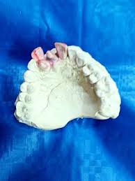 Hyperdontia - Wikipedia
