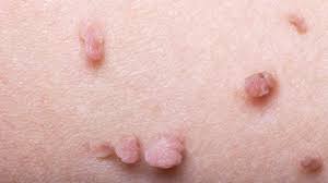 Here's why ingrown hairs form and how you can get rid of what is an ingrown hair? Genital Skin Tags Or Warts From Hpv Symptoms Removal And More