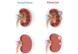 Laboratory evaluation of renal function. Renal Cysts Urologist Singapore Urohealth Medical Clinic