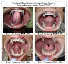Soroush Zaghi Md Highly Specialized Snoring And Sleep Apnea Surgeon Tongue Tie Functional Ankyloglossia Tongue Tie Oral Surgeon Oral Health Education