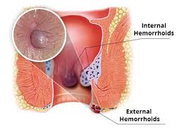 Hemorrhoids are usually not dangerous, but they can cause itching, discomfort, and bleeding. Hemorrhoid Treatment Specialist Nyc New York City Hemorrhoid Doctor