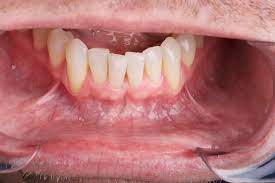 There is a wide range in how oral cancer may look and feel. Self Oral Cancer Screening Socs Education Program School Of Dentistry Lsu Health New Orleans