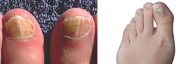 Foot fungus is a type of contagious disease that is caused by an infection with a microscopic fungus. Fungal Nail Infections Fungal Diseases Cdc