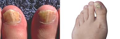 fungal nail infections fungal