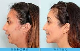 Image Result For Orthognathic Surgery Overbite Orthognathic Surgery Jaw Surgery Corrective Jaw Surgery