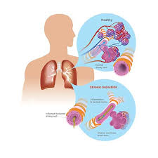 Image result for Acute Bronchitis