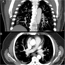 D caruso, m zerunian, m polici, f pucciarelli, t polidori, c rucci, g guido Vista De Dimero D Elevado Y Tromboembolismo Pulmonar Agudo En Pacientes Con Covid 19 Journal Of Negative And No Positive Results