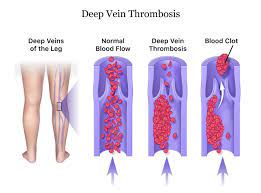 Other times, blood clots are found by accident when checking for other things. Deep Vein Thrombosis Dvt Warnings Signs Treatment