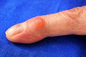 Das hilft bei arthrose in der hand. Arthrose Hand Finger Hannover Mukoid Zyste Spezialist Empfehlung