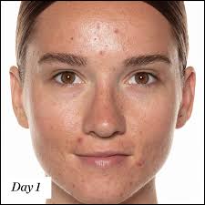 Image result for acne face