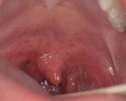 Image result for Strep throat infection roof of mouth