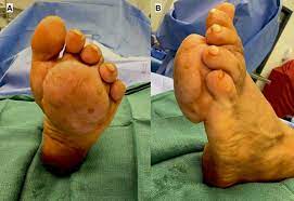 Scientists have discovered 7 types of bacteria and 18 types of fungus that can cause madura foot. Chronic Madura Foot Mycetoma And Or Actinomyces Spp Or Actinomycosis Bmj Case Reports