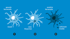 Pramipexole extended release in parkinson's disease. Parkinson Konnte Bald Heilbar Sein Focus Arztsuche