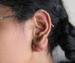 Keloid Associated With Ear Piercing