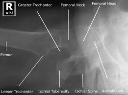 Radiographic Anatomy Hip Horizontal Ray With Images Radiology Radiology Schools Radiology Student