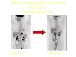 Ulcers do not always cause symptoms. Gastric Cancer Cancer Therapy Advisor