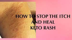 How To Heal Keto Rash Keto Rash Rash Treatment Keto